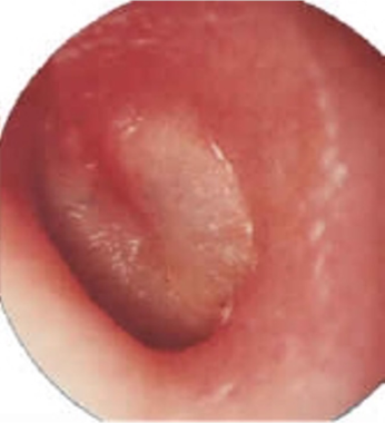 antibioest nl tympan relief 